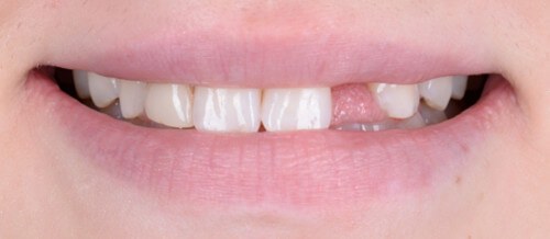 Before and after dental treatment at Wylie Dentistry Co.