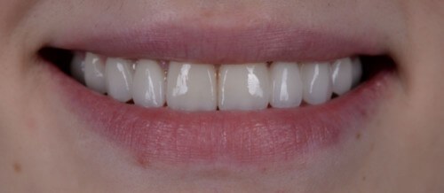 Before and after dental treatment at Wylie Dentistry Co.