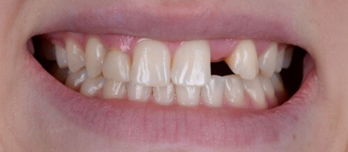 Before and after dental treatment at Wylie Dentistry Co.