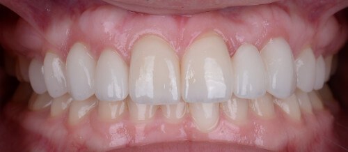 Before and after dental treatment at Wylie Dentistry Co.