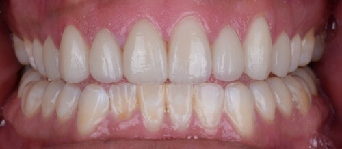 Before and after dental treatment at Wylie Dentistry Co.
