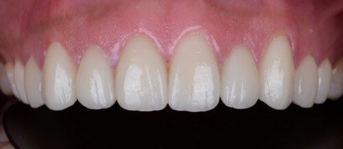 Before and after dental treatment at Wylie Dentistry Co.