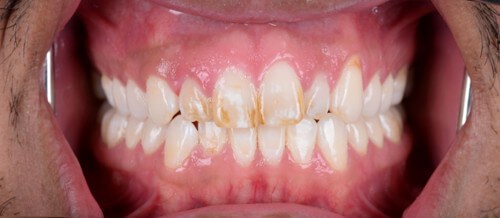 Before and after dental treatment at Wylie Dentistry Co.