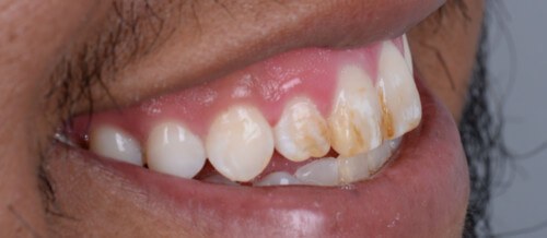 Before and after dental treatment at Wylie Dentistry Co.