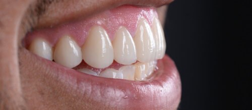 Before and after dental treatment at Wylie Dentistry Co.