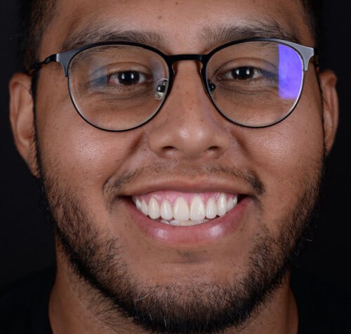 Before and after dental treatment at Wylie Dentistry Co.