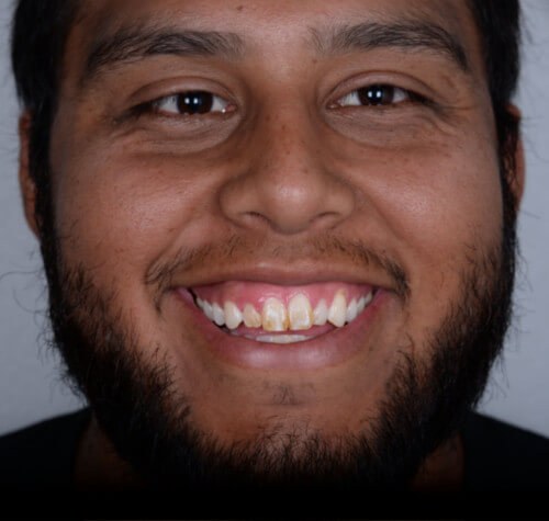 Before and after dental treatment at Wylie Dentistry Co.