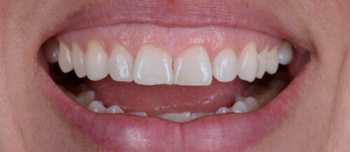 Before and after dental treatment at Wylie Dentistry Co.