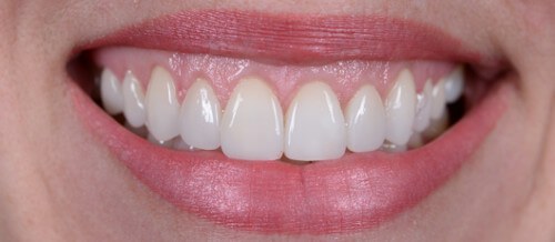 Before and after dental treatment at Wylie Dentistry Co.
