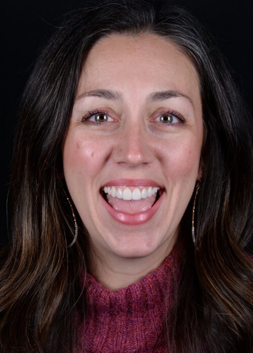 Before and after dental treatment at Wylie Dentistry Co.
