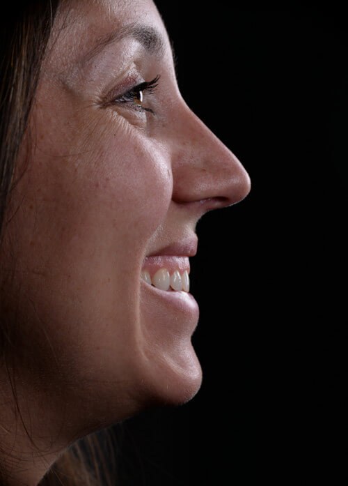 Before and after dental treatment at Wylie Dentistry Co.