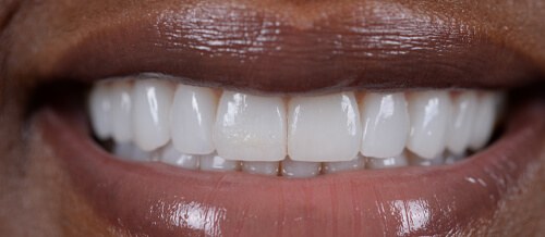 Before and after dental treatment at Wylie Dentistry Co.