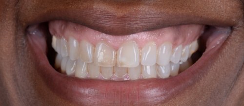 Before and after dental treatment at Wylie Dentistry Co.