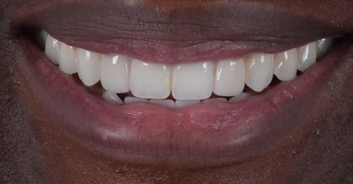 Before and after dental treatment at Wylie Dentistry Co.