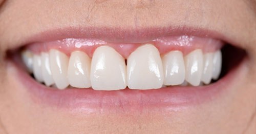 Before and after dental treatment at Wylie Dentistry Co.