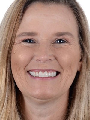 Before and after dental treatment at Wylie Dentistry Co.