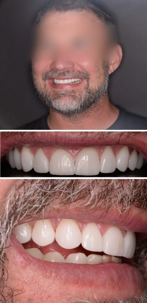 Before and after dental treatment at Wylie Dentistry Co.