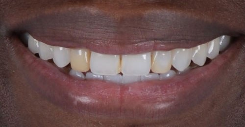 Before and after dental treatment at Wylie Dentistry Co.