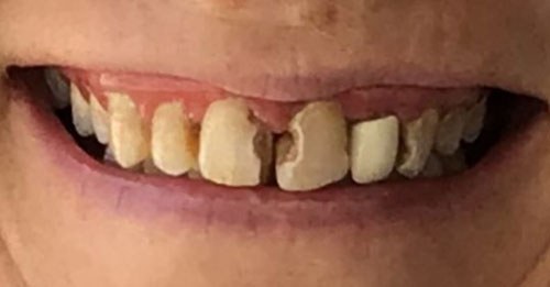 Before and after dental treatment at Wylie Dentistry Co.