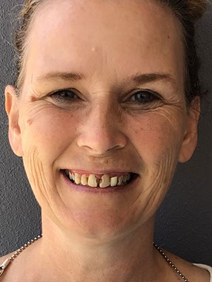 Before and after dental treatment at Wylie Dentistry Co.