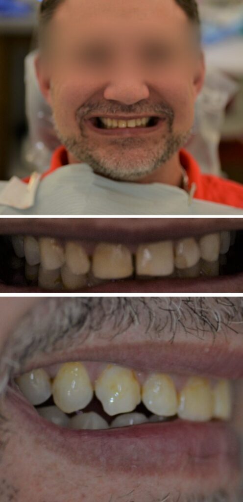 Before and after dental treatment at Wylie Dentistry Co.