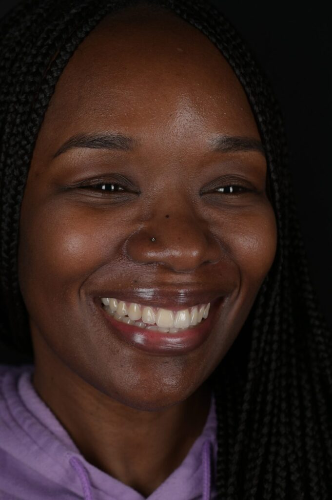 The same patient smile after treatment at Wylie Dentistry Co.