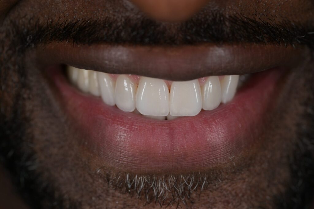 Close-up of a patient smile after treatment
