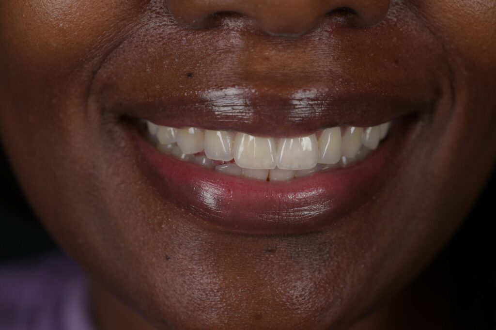 Close-up of a patient smile after treatment