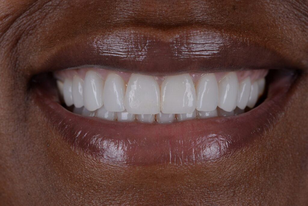 Close-up of a patient smile after treatment